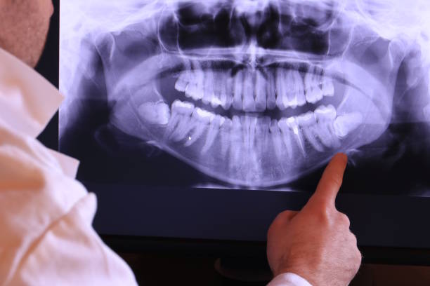 Best Knocked-Out Tooth (Avulsed Tooth) Treatment in Beardstown, IL