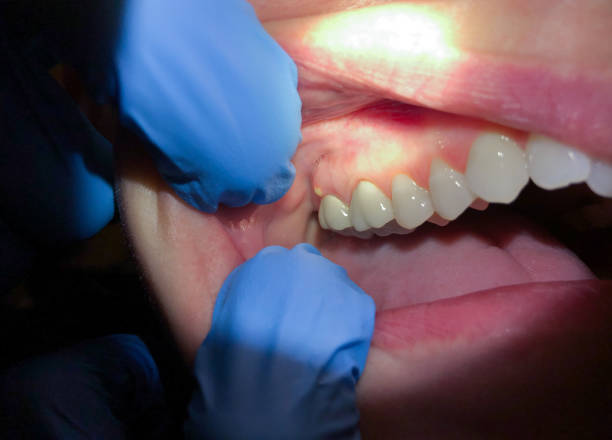 Best Emergency Root Canal Therapy in Beardstown, IL