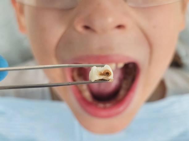 Best Walk-In Emergency Dental Services in Beardstown, IL
