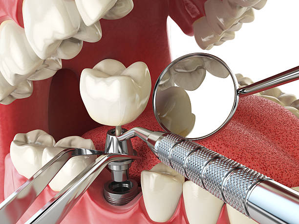 Best Broken or Chipped Tooth Repair in Beardstown, IL